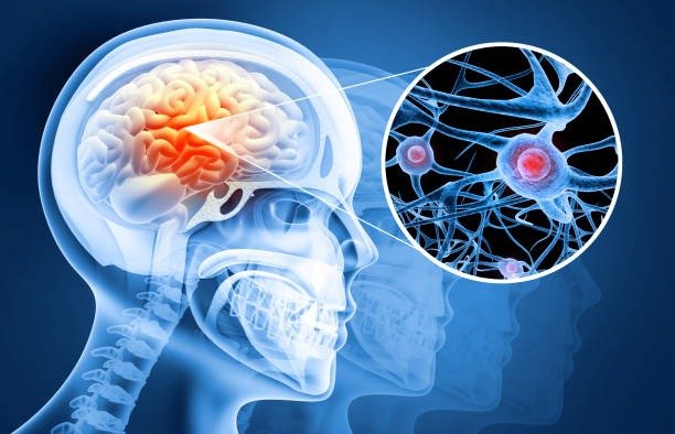 Best Neurological Treatments in Noida